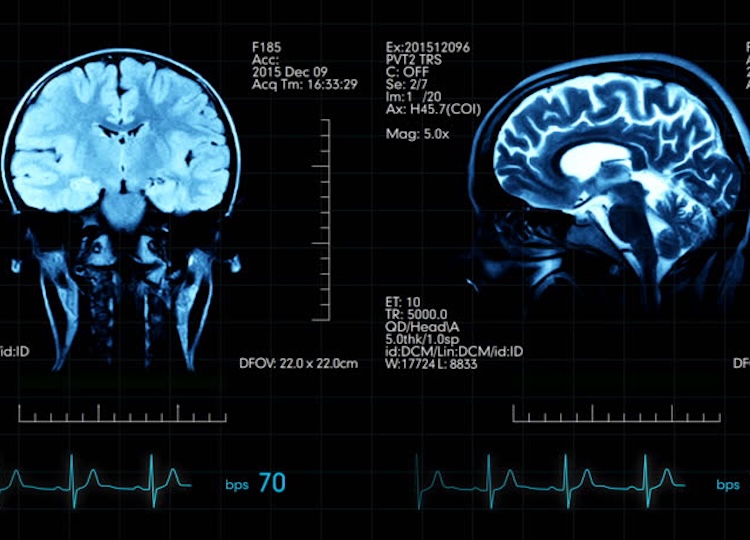 brain scan